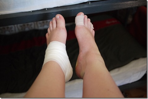 Blister, bruised, swollen feet - el Camino de Santiago, Camino Frances, Spain